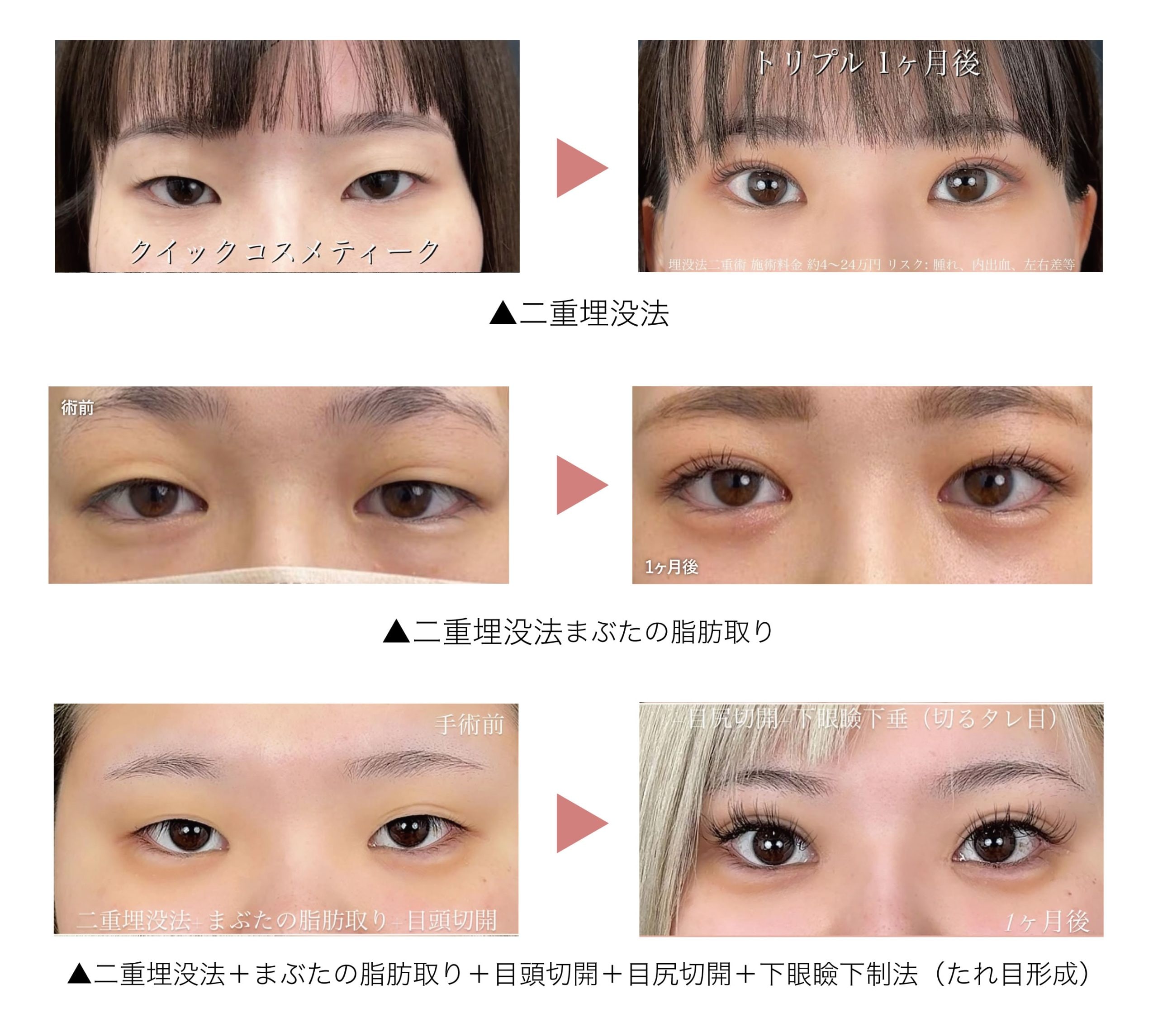 埋没法